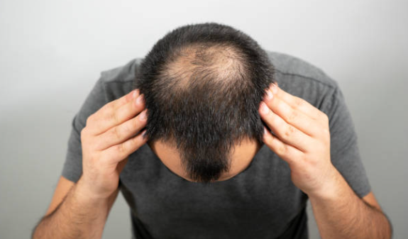 Greffe de cheveux
