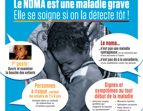 Le noma (MTN), maladie grave, mais évitable Le noma inscrite sur la liste des maladies tropicales négligées.